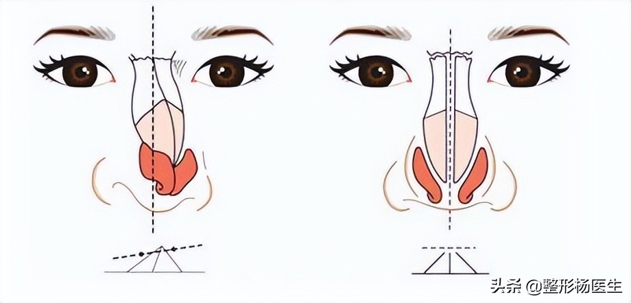 注射隆鼻和假体隆鼻哪个好,隆鼻和综合隆鼻整形有什么区别