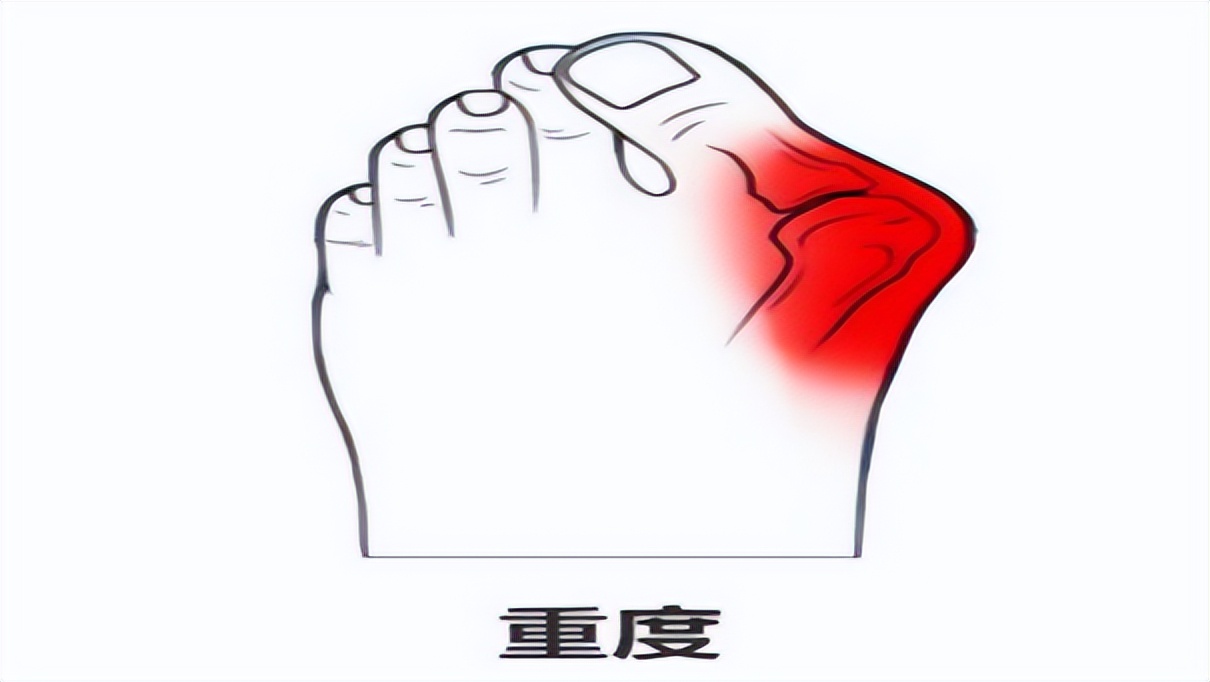 大拇脚趾往里歪怎么矫正,严重拇外翻脚趾畸形怎么办