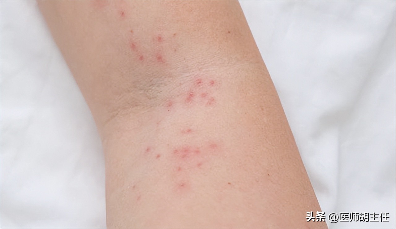 别把艾滋病当皮肤病治,不要错把艾滋病当皮肤病