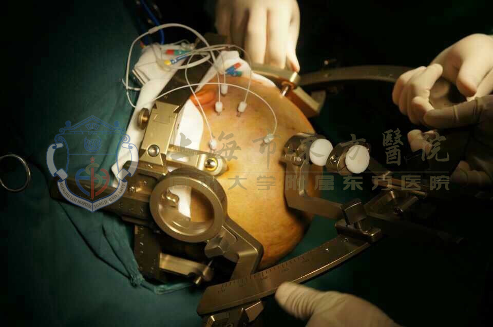 药物无法控制的癫痫,癫痫药物控制几年不发作算痊愈