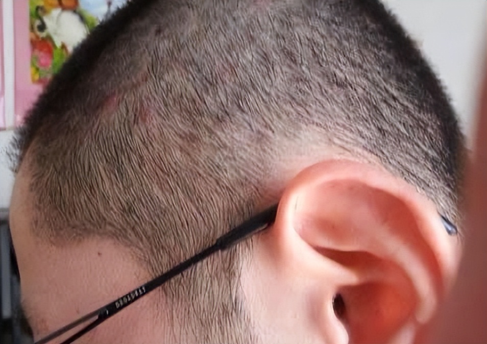 头皮上长疙瘩和脓包是怎么回事,头皮总是长疙瘩或脓包是什么原因