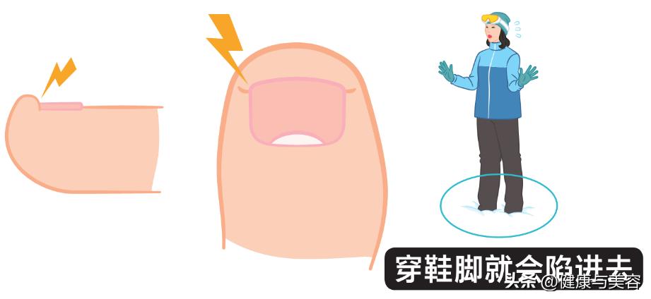 指甲卷曲内卷,指甲卷曲用什么药