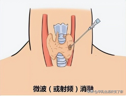 甲状腺结节微波消融最好的医院,临沂医院有甲状腺结节微波消融