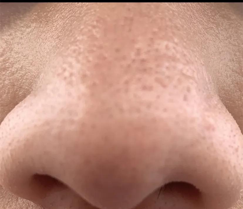 鼻子黑头里挤出的白色油脂怎么办,鼻子上有硬硬的黑头怎么办