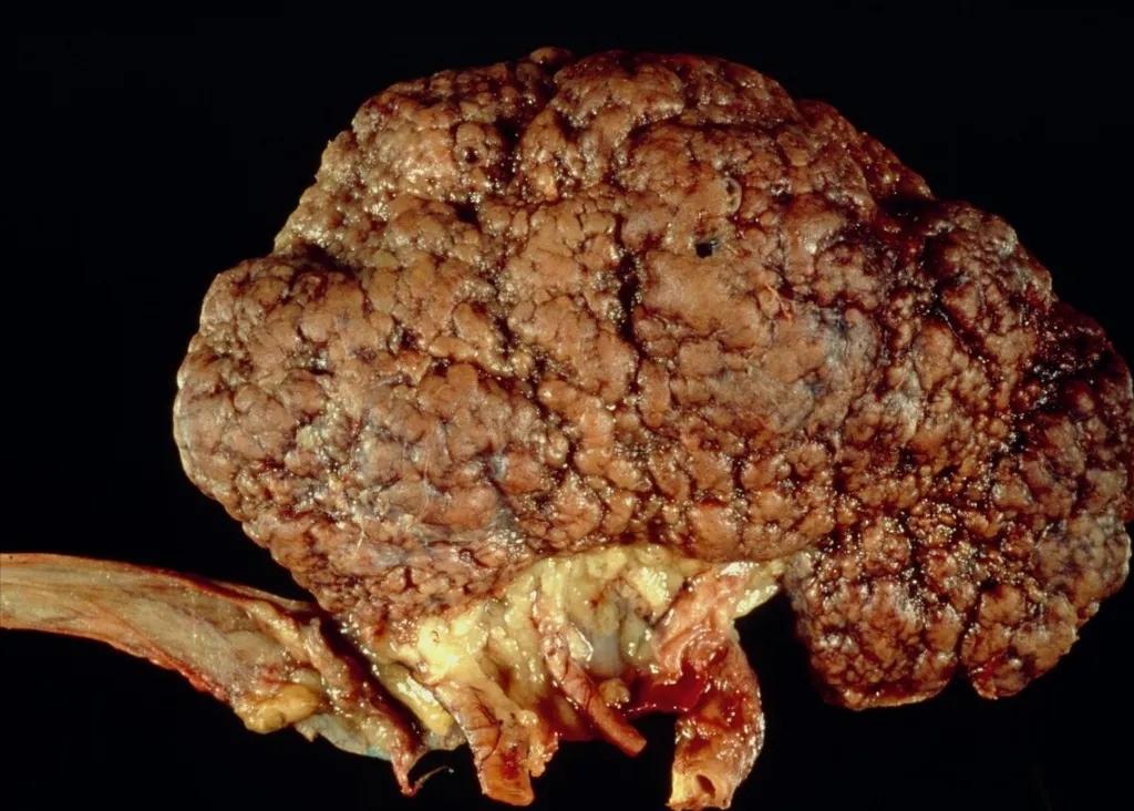 间质性肾炎真的无药可治吗？