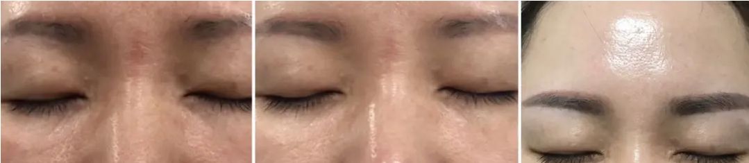 烂脸油皮爆痘红怎么修复,脸干起皮有红血丝怎么补水最有效