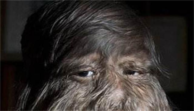 女生因为多毛症被歧视,身患多毛症