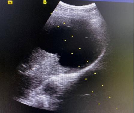 介入穿刺全过程,介入穿刺技术