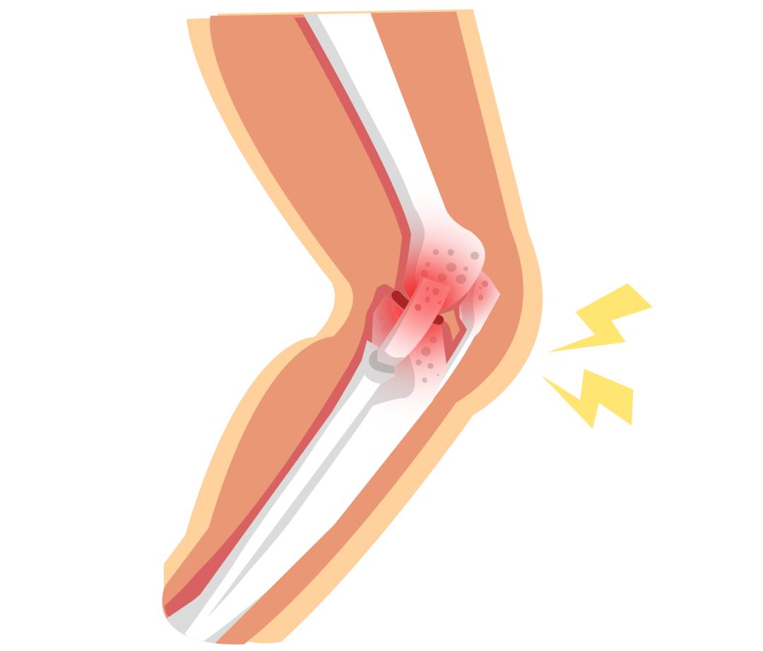 中老年骨折吃什么钙片补钙效果好,老年人骨折愈合全过程