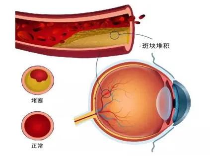 不痛不痒，突发单眼看不见，只有光感，原因？怎么应对？