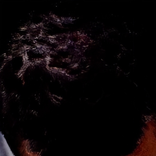 头皮脂溢性皮炎头皮红有皮屑,脂溢性头皮皮炎需要怎么治疗