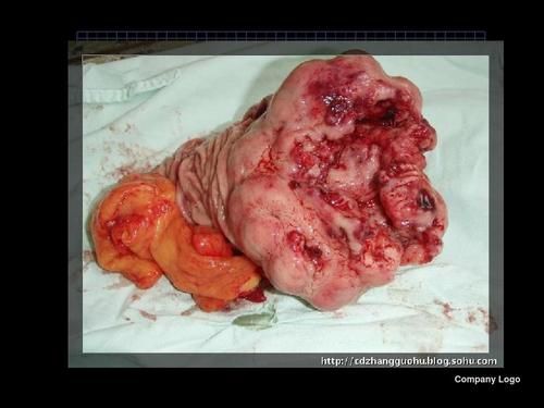 腺癌的症状和前兆,转移性腺癌属于什么癌症