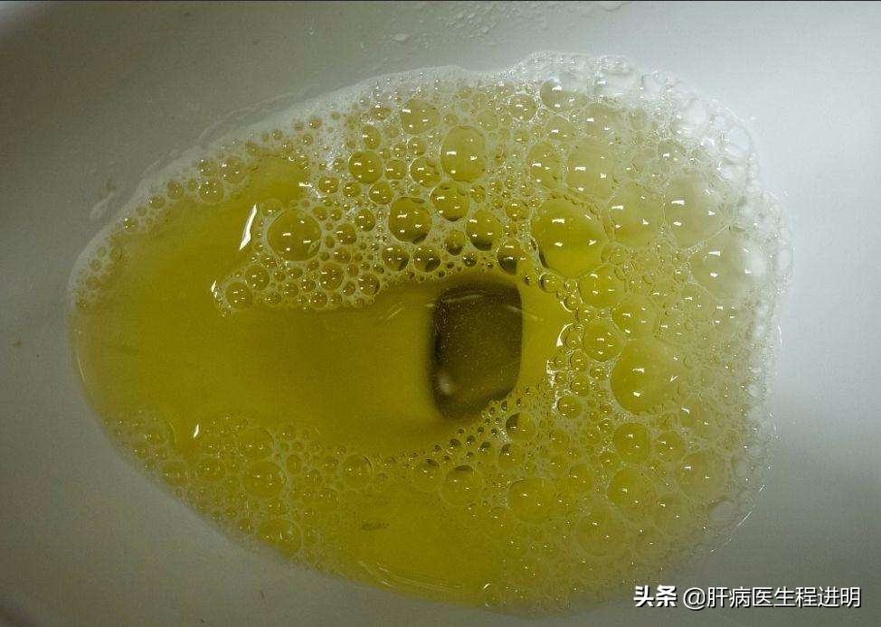 酒后肝脏部位隐隐作痛吃什么药,酒后这4个反应暗示肝脏扛不住了