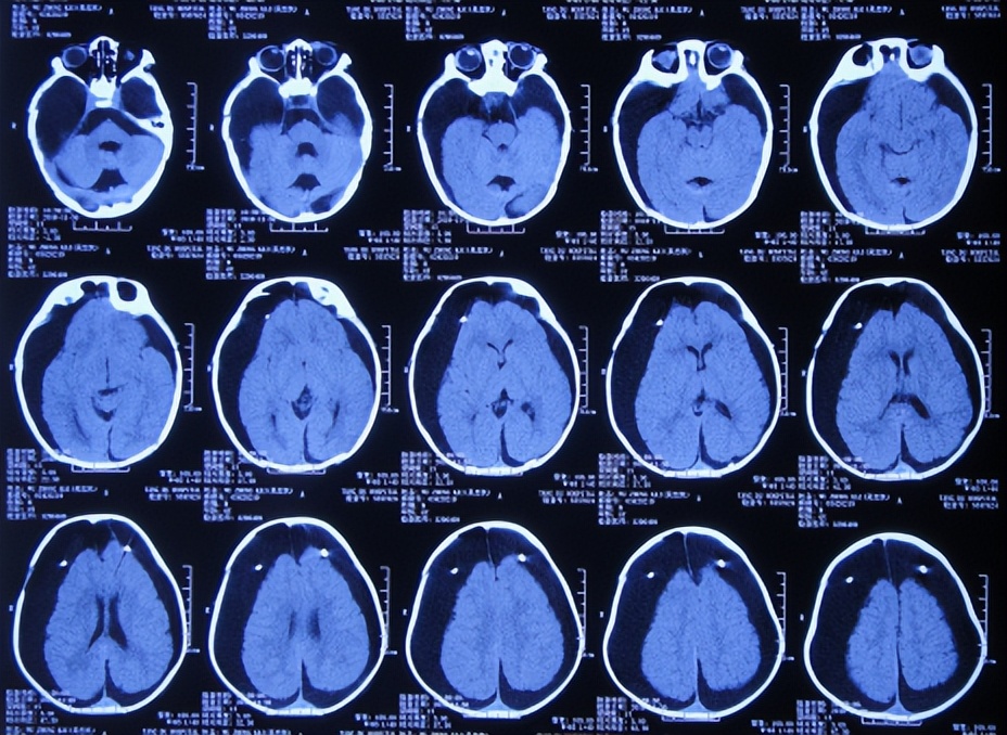 蛛网膜囊肿合并脑积水腹腔分流术,治疗蛛网膜囊肿引起脑积水严重吗
