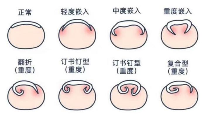 脚趾甲往肉里长又疼又痒教你一招,脚趾甲总往肉里扎该怎么办
