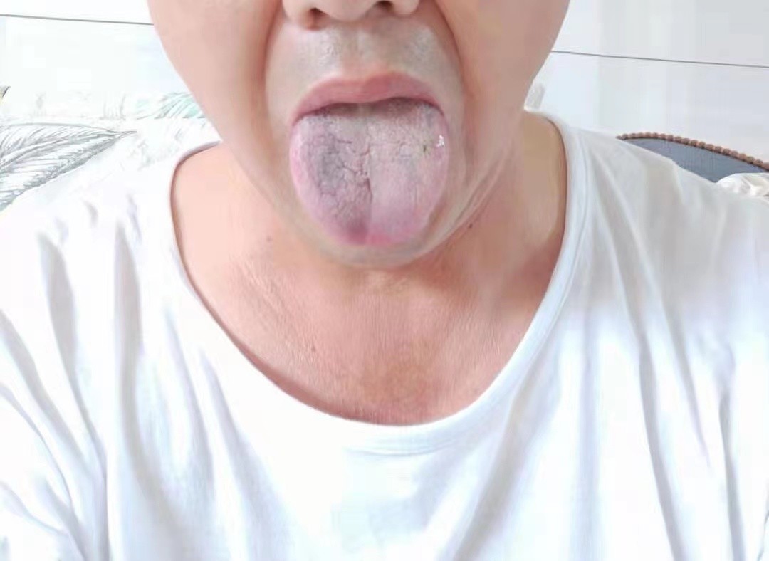 老年人缺血性肠炎,缺血性肠炎出血怎么治疗