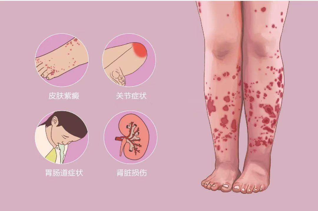 22岁女孩腿上有红色紫色小点点,小孩腿上有瘀斑需要做骨髓穿刺吗