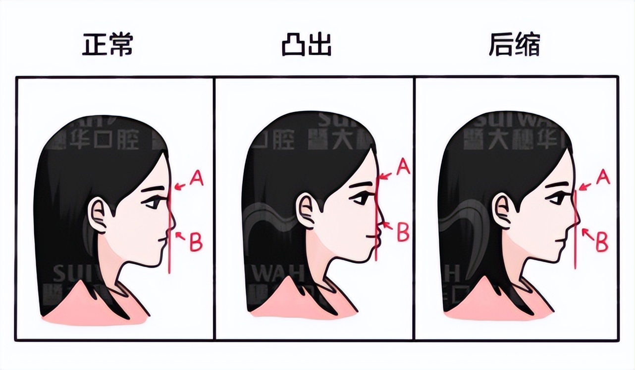 牙齿矫正拔牙和不拔牙有什么区别,牙齿矫正拔牙当天就可以矫正了吗
