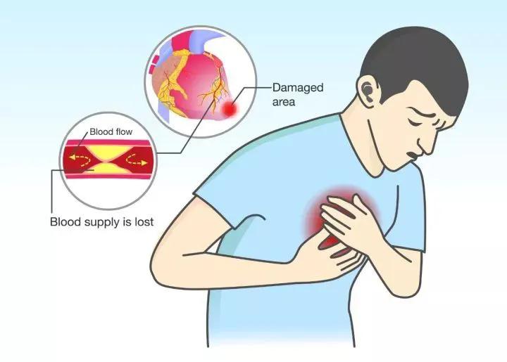 冠脉狭窄多少算是冠心病,冠脉狭窄超过50%可以诊断冠心病吗