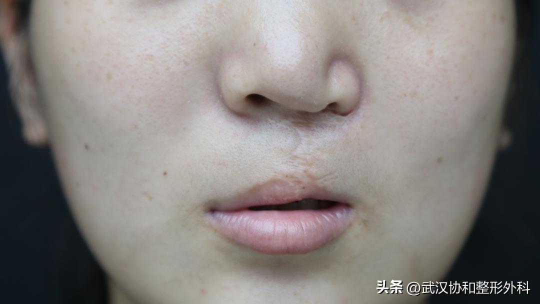 唇腭裂做一次手术就好了吗,唇腭裂一次性做完鼻子好吗