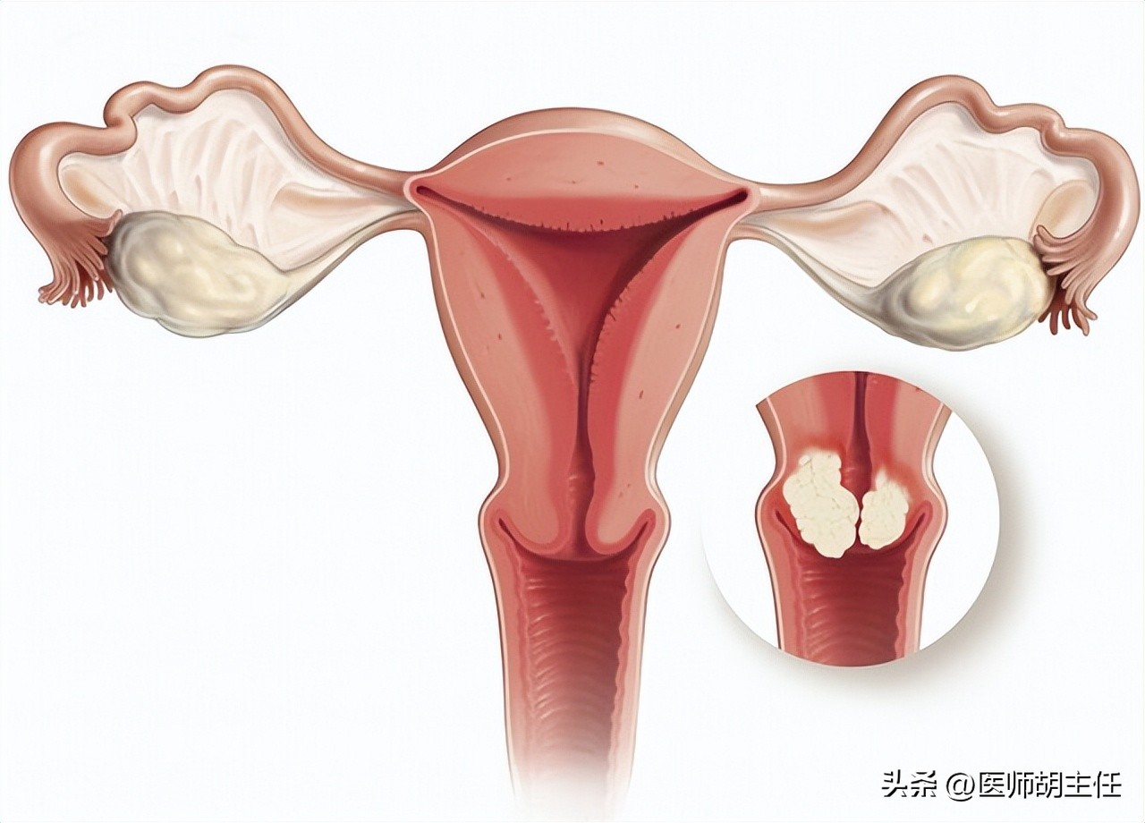 宫颈癌的前兆会不会腿痛,宫颈癌有一项异常会怎样