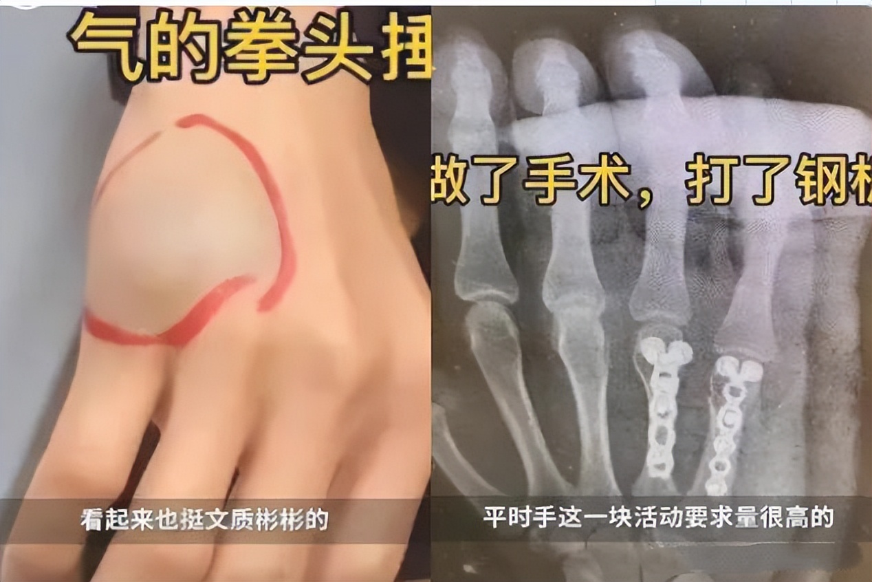 父亲拍断手骨,这得生多大的气?他为何怒发冲冠?一问,憋不住笑