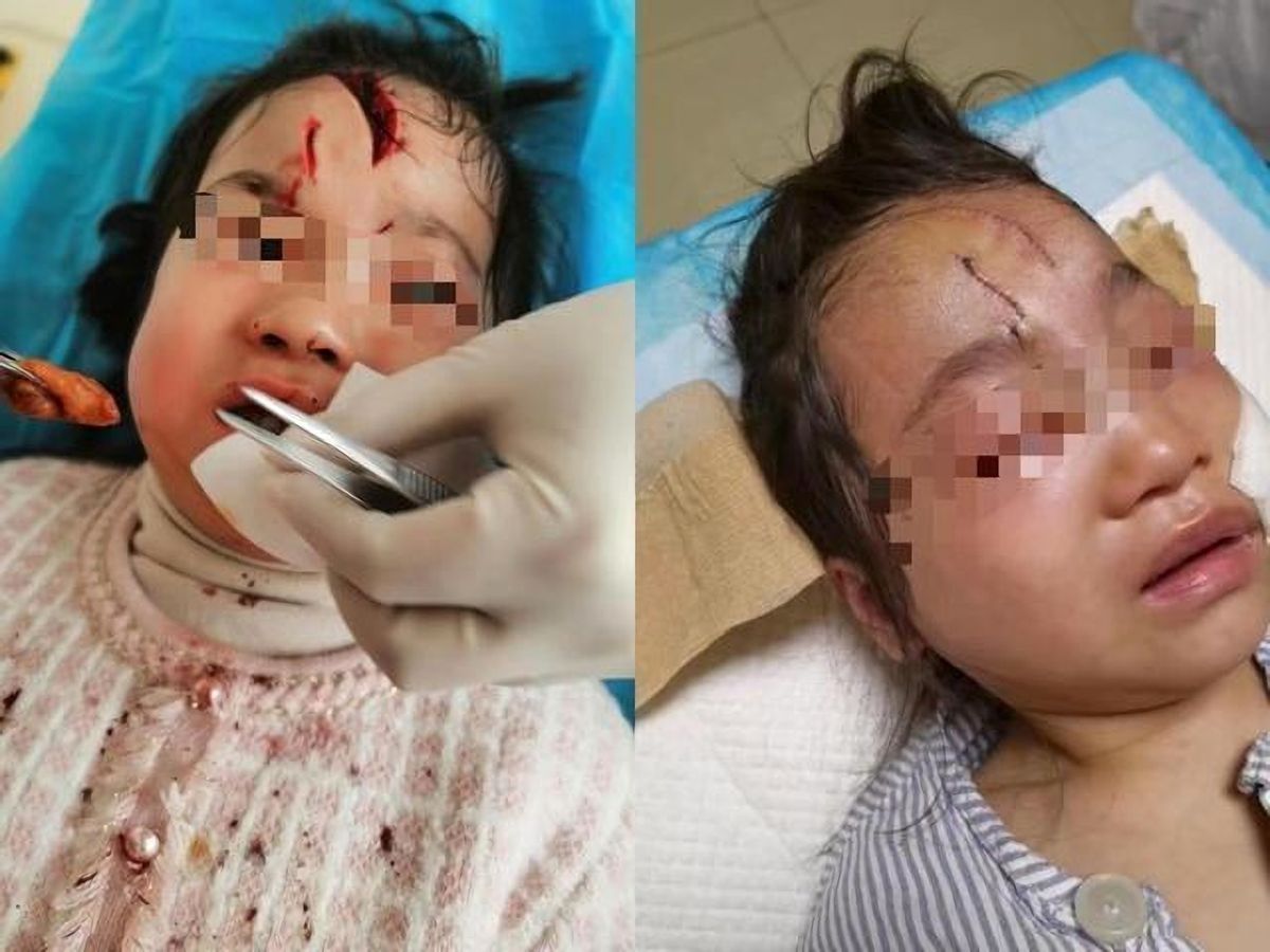 女童被狗咬伤后续狗主人,女童被大型犬咬伤原视频