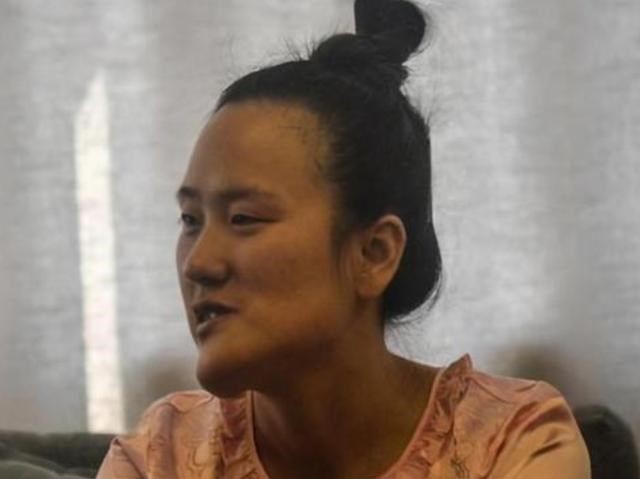 女孩因高烧毁容，后获郭明义帮助整形成功，高颜值引网红公司争抢