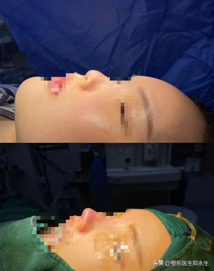 修复隆鼻不满意最佳取出时间,如何进行隆鼻失败修复