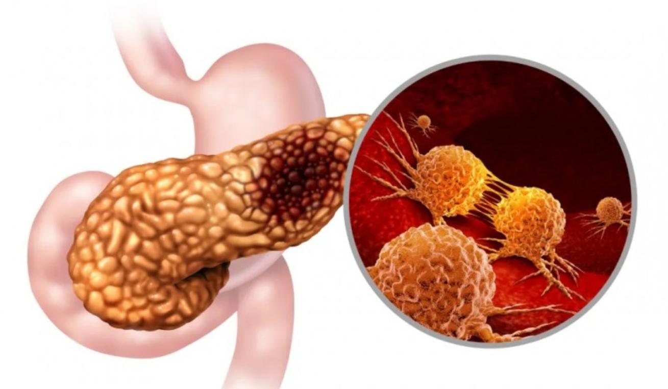 上腹部疼如何区分胃病和胰腺癌,胃痛不一定都是胃病要警惕胰腺癌