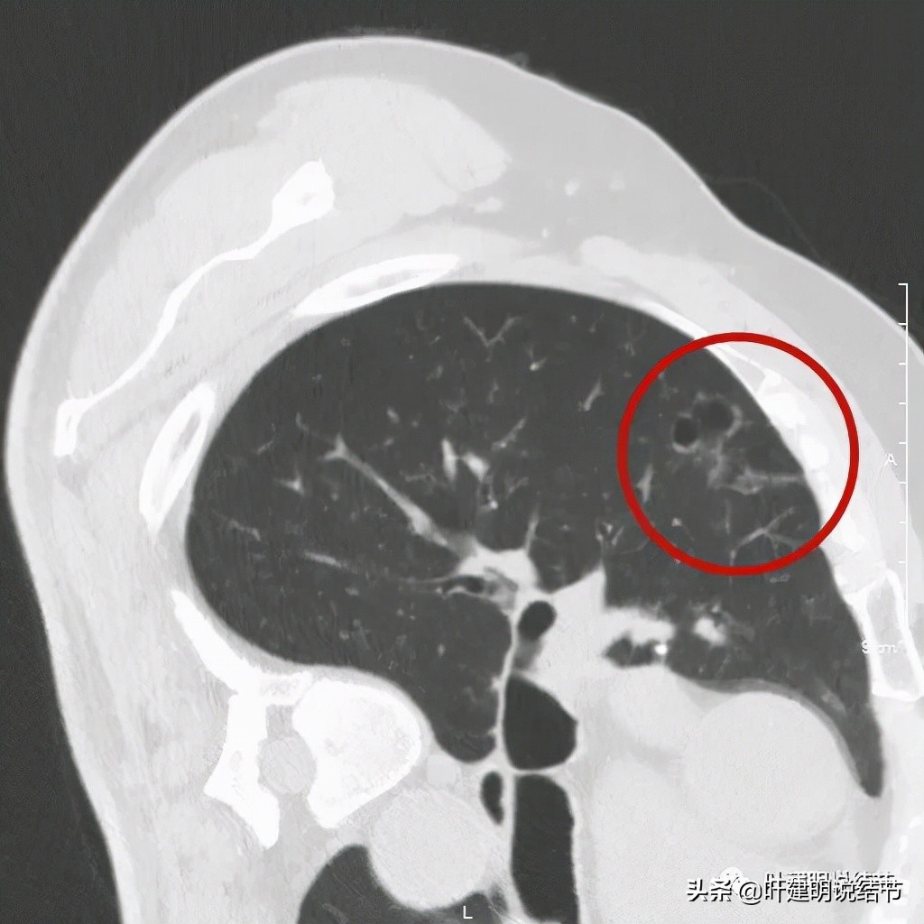肺多发结节切除一个剩下的怎么办,无限纠结的肺小结节
