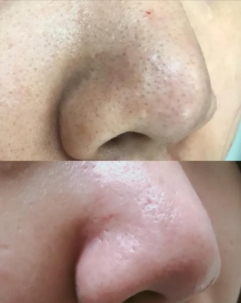 去鼻子上的黑头最好的方法,去鼻子上黑头的有效方法