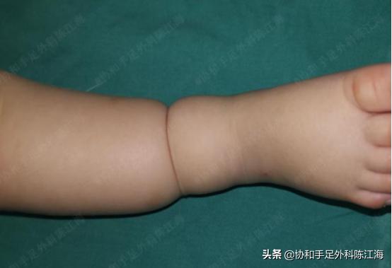 宝宝36周出生要紧吗,宝宝出生37天脐带没有脱落