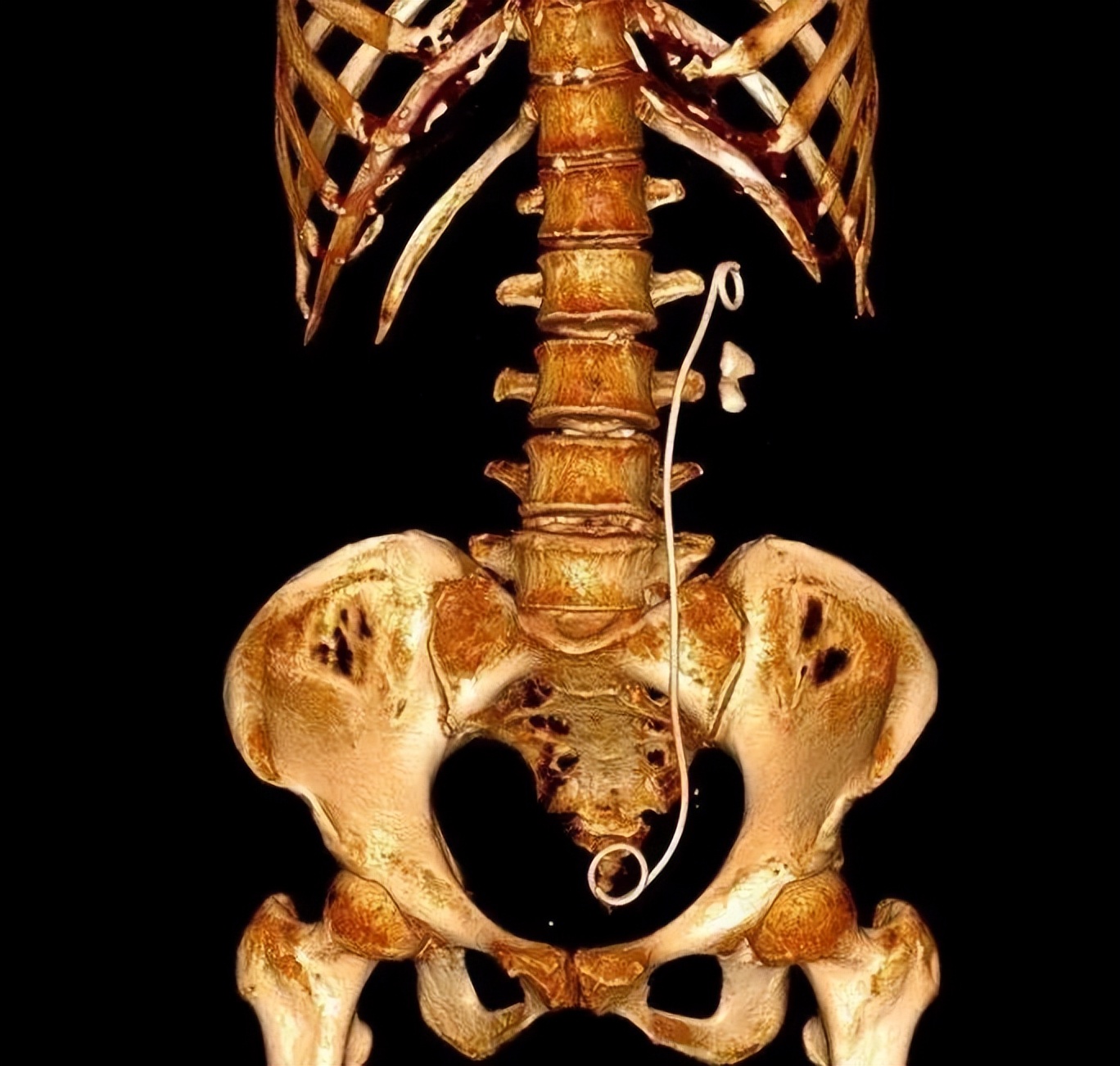 彩超和ct查结石哪个准确,做彩超可疑结石有必要做ct