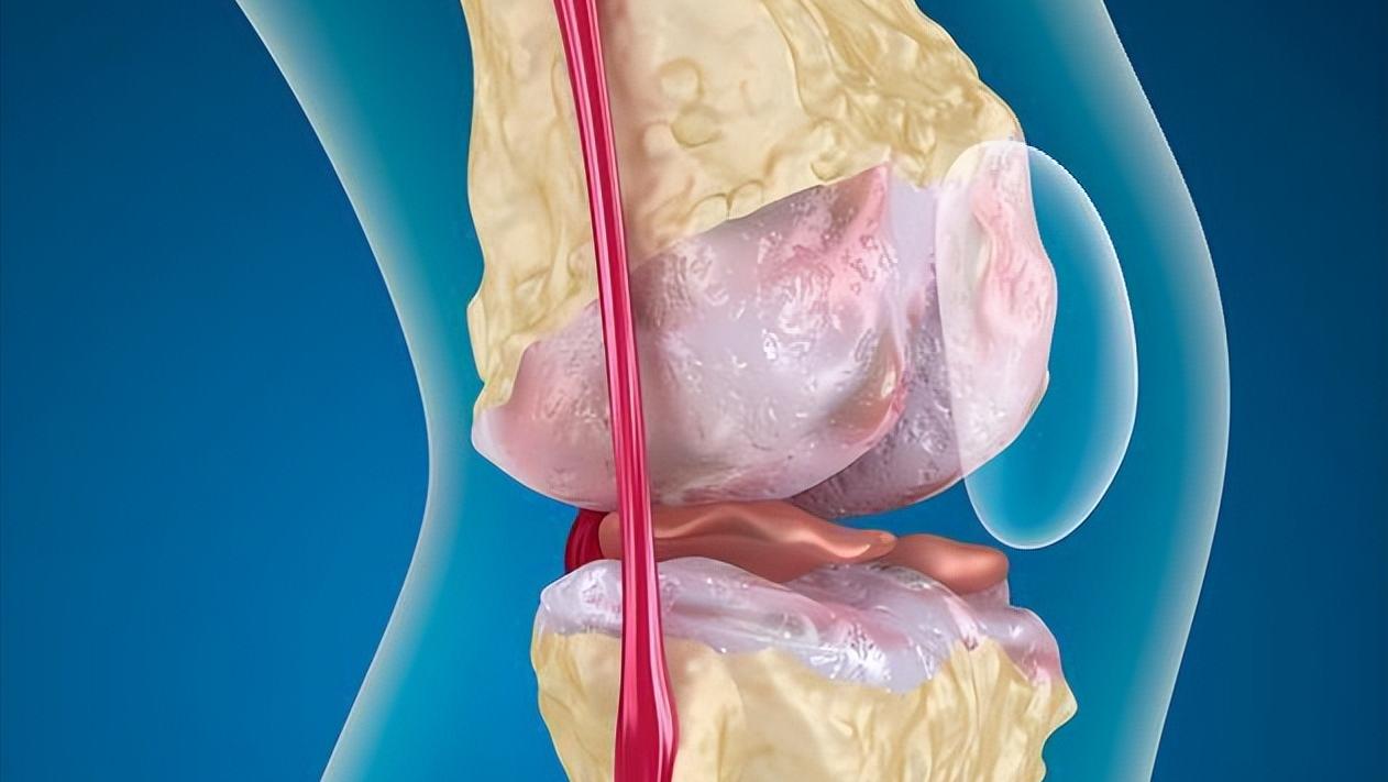 滑膜炎怎么恢复注意什么,滑膜炎怎样治疗才能快速恢复