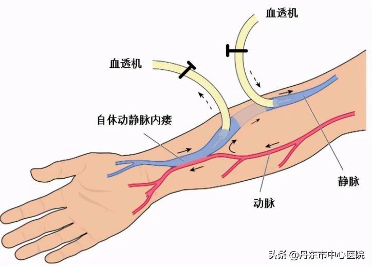 疫情·科普|疫情防控ing，血液透析患者如何进行居家护理？