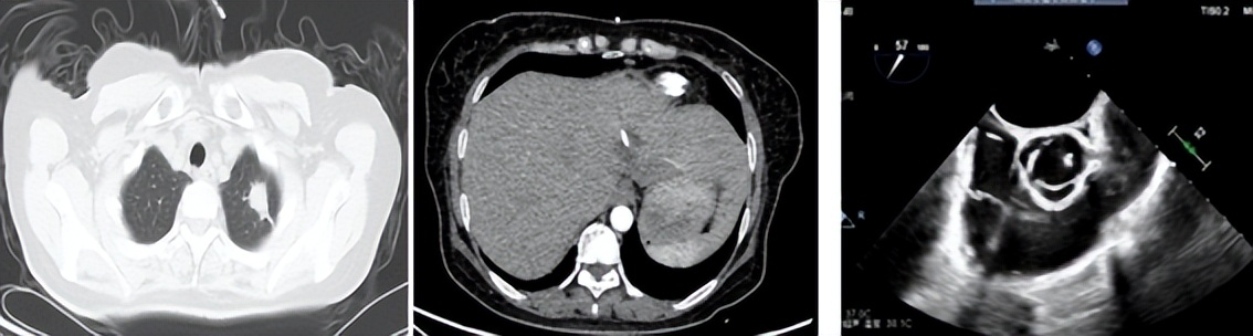 肺炎克雷伯菌侵袭眼内可治愈吗,高毒性肺炎克雷伯菌