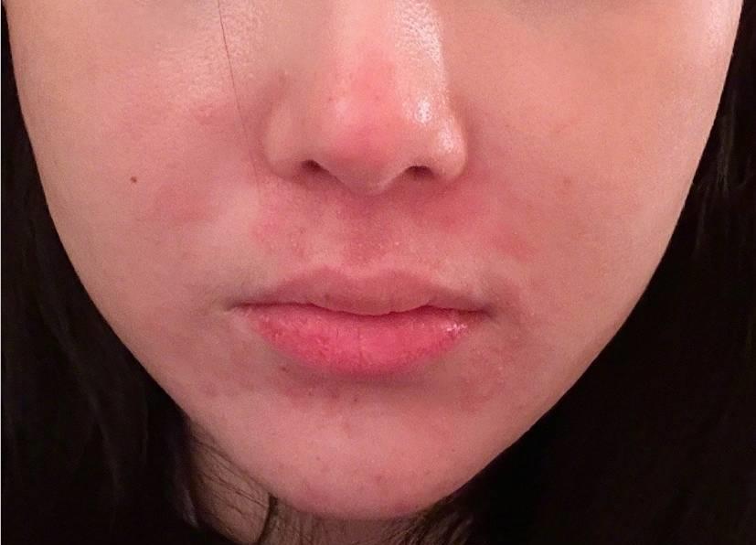 张馨予过敏皮炎第几期,张馨予皮肤过敏涂的什么