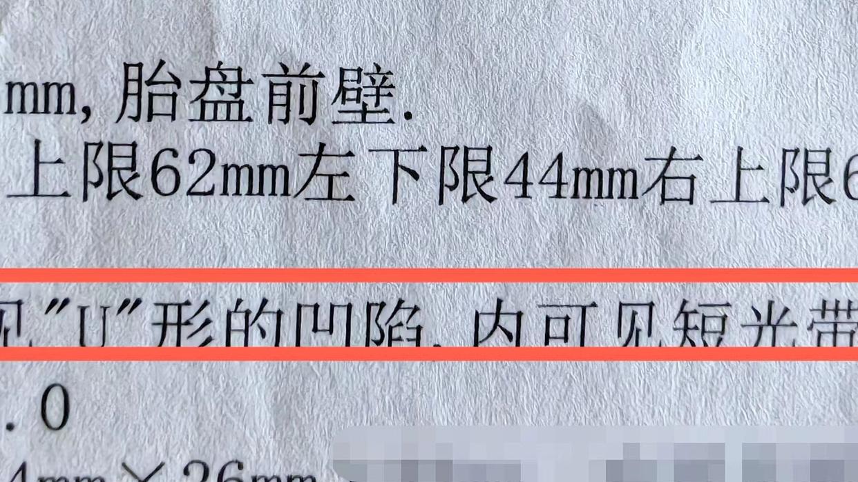 怀孕22周脐带绕颈最严重的后果,孕32周怎么防止宝宝脐带绕