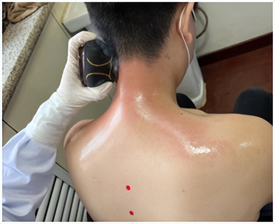 阳后怎么缓解肩背疼痛,阳后背部肩部疼痛