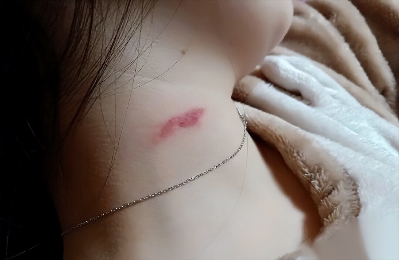 妻子和丈夫同房，被丈夫“种草莓”，第二天匆匆赶到医院，为何？