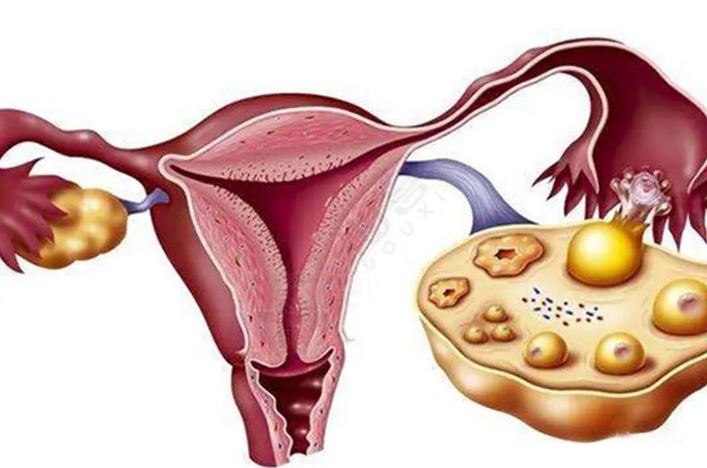 多囊不孕怎么治疗最好,多囊不孕怎么调整心态