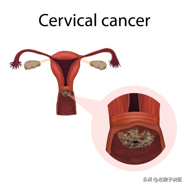 脖子上的“小肉球”是怎么一回事？可以用手抠掉吗？告诉你答案