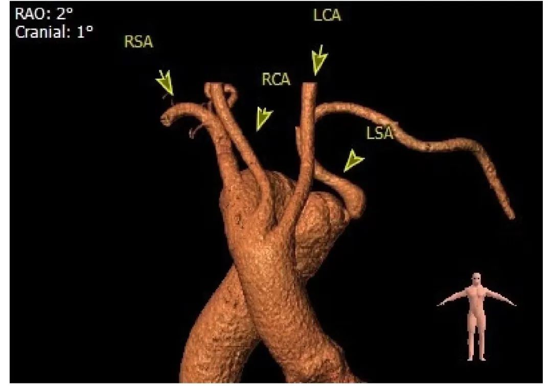 主动脉夹层救活的几率大不大,主动脉夹层腔内重建修复术