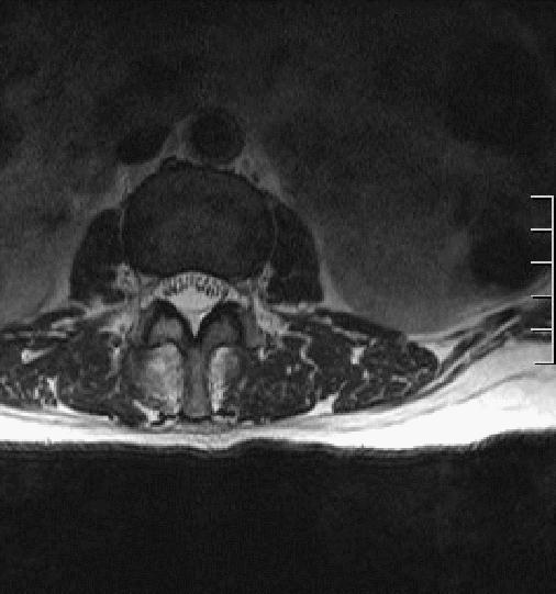 脊索瘤造成骨质破坏严重吗,多发椎体骨质破坏考虑转移瘤