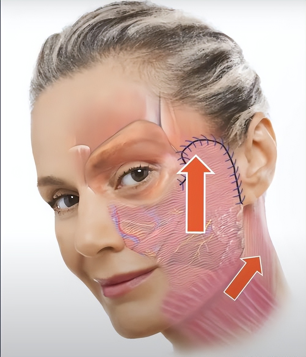 全脸拉皮手术前后6天的效果,拉皮手术多长时间能全部消肿