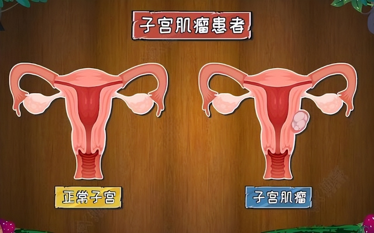 查出子宫肌瘤，能吃西瓜吗？医生：不想肌瘤增大，这5物尽量少吃