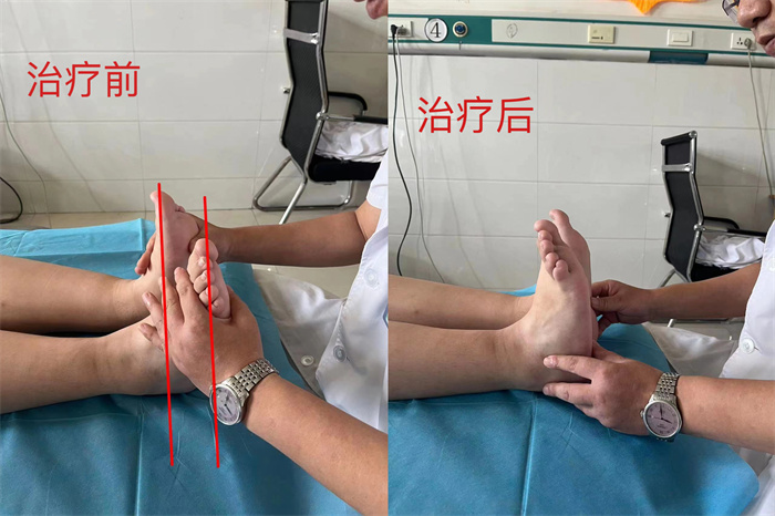 莱矿医院运动康复,莱矿康复医院怎么样