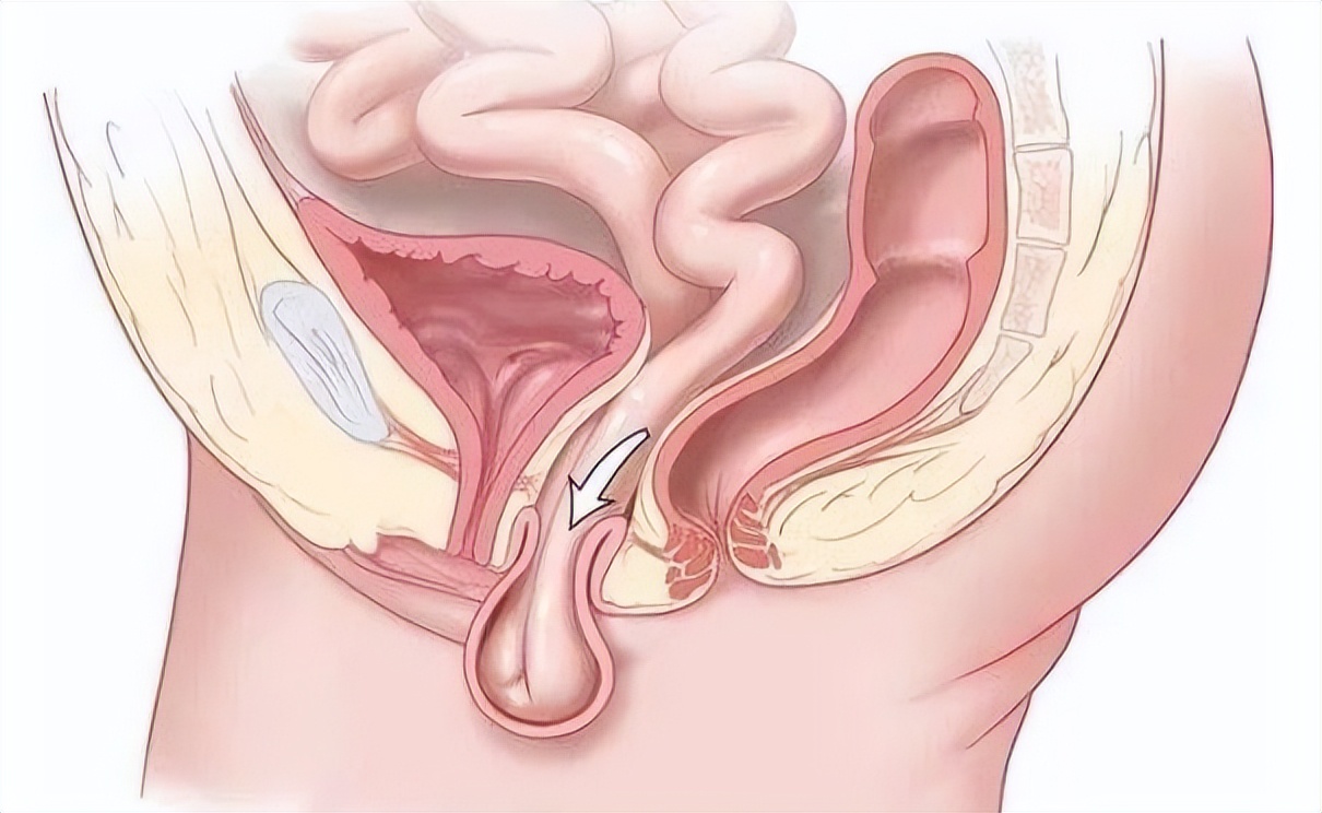 子宫脱垂对女性的危害都有哪些呢,子宫脱垂为何不能根治
