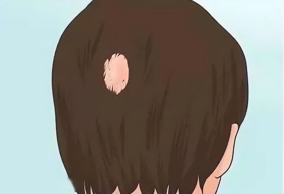 白发、脱发，头部白癜风不治疗的危害可不止这些